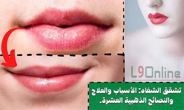 تشقق الشفاه الدائم: الأسباب والعلاج الفعال والوقاية.
