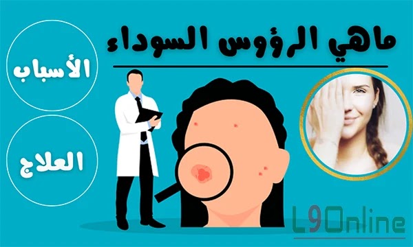 الرؤوس السوداء: أسبابها ونصائح ذهبية لإزالتها